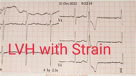 lv strain pattern|lv strain pattern ekg.